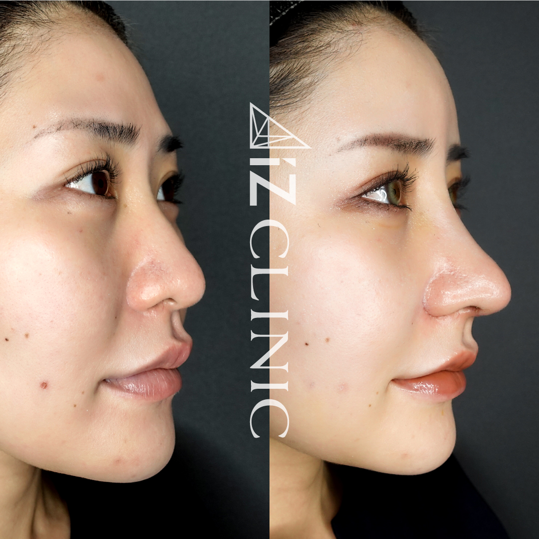 プロテーゼ 鼻の整形なら美容外科 美容皮膚科aizクリニック Aizクリニック アイズクリニック 美容外科 美容皮膚科