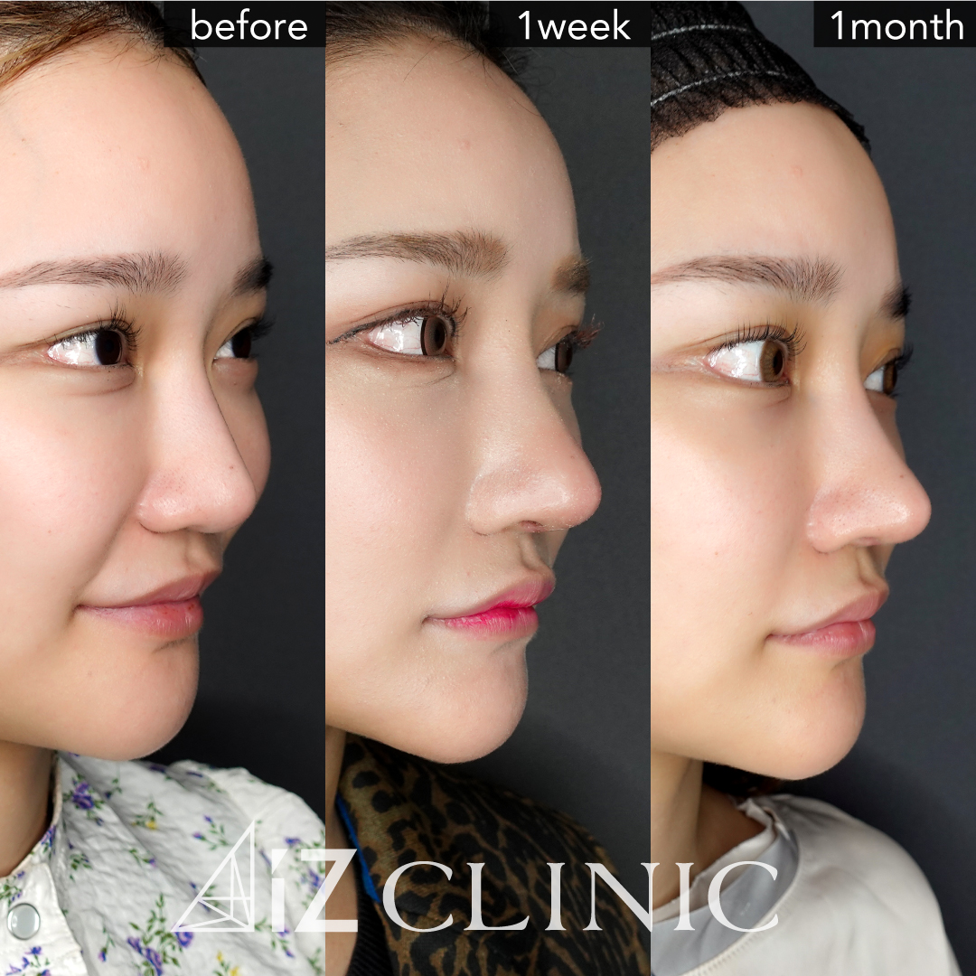 プロテーゼ 鼻の整形なら美容外科 美容皮膚科aizクリニック Aizクリニック アイズクリニック 美容外科 美容皮膚科