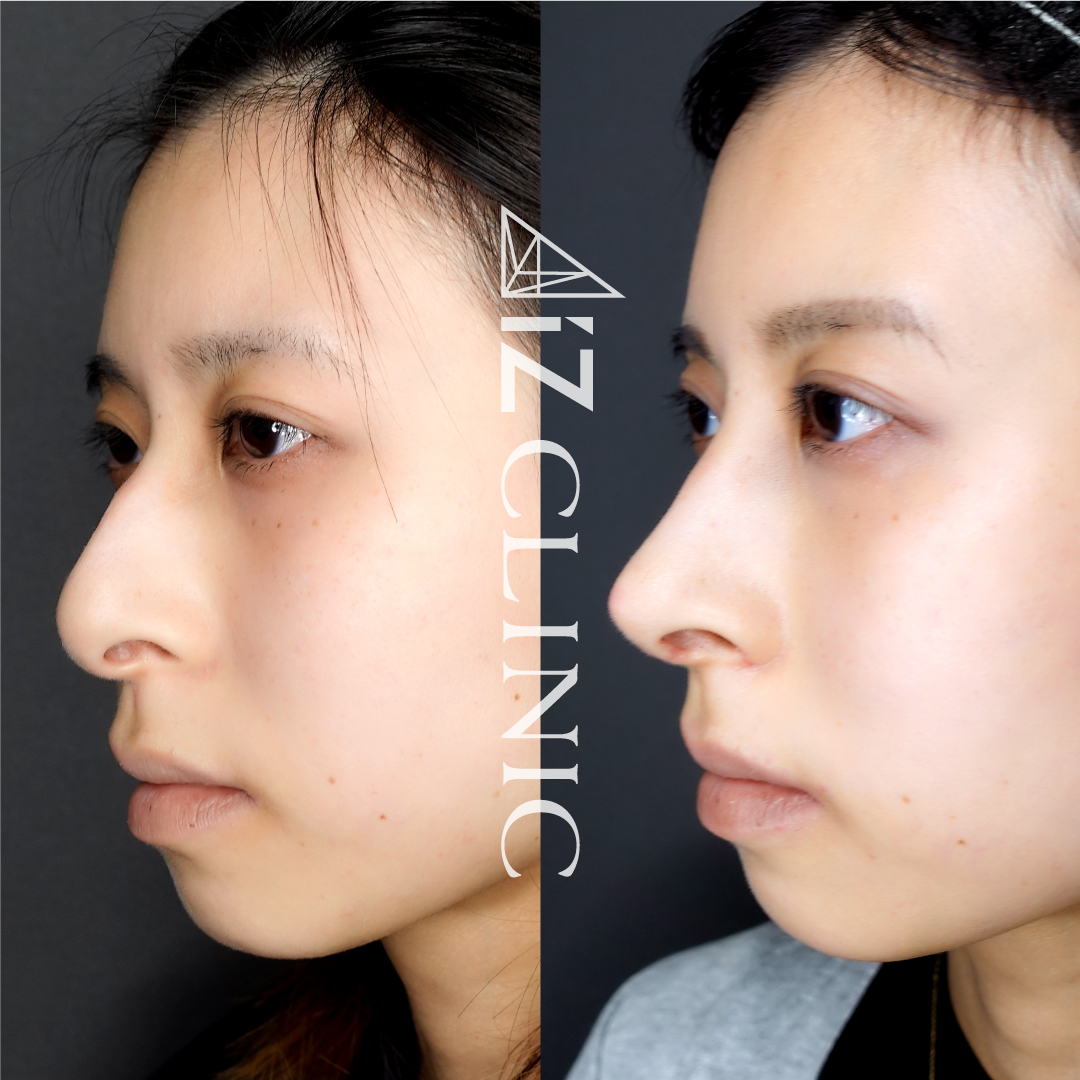 鼻尖形成術で鼻の整形なら美容外科 美容皮膚科aizクリニック 東京 表参道のaizクリニック アイズクリニック