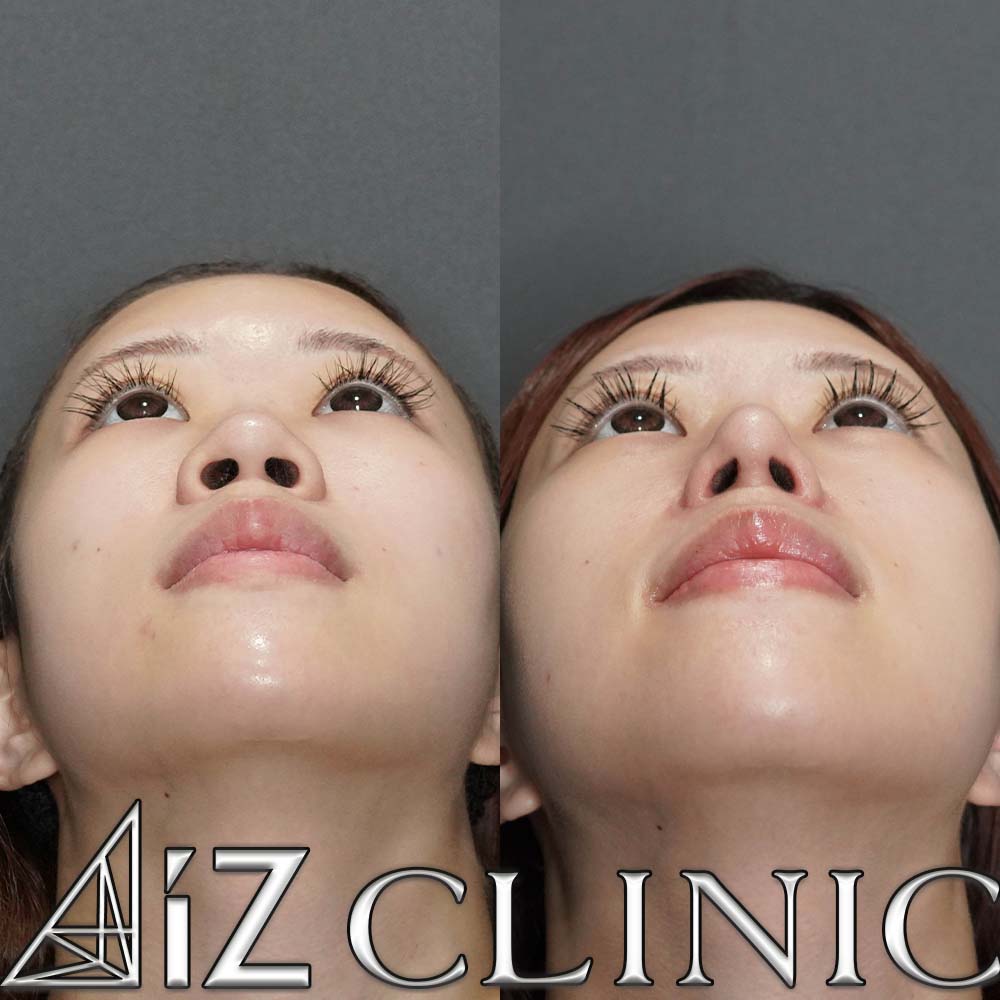 鼻中核延長、鼻尖形成ストラット法、小鼻縮小の一例