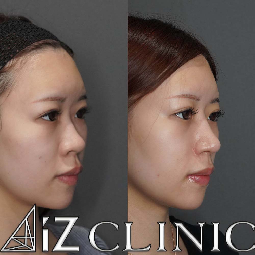 鼻中核延長、鼻尖形成ストラット法、小鼻縮小の一例