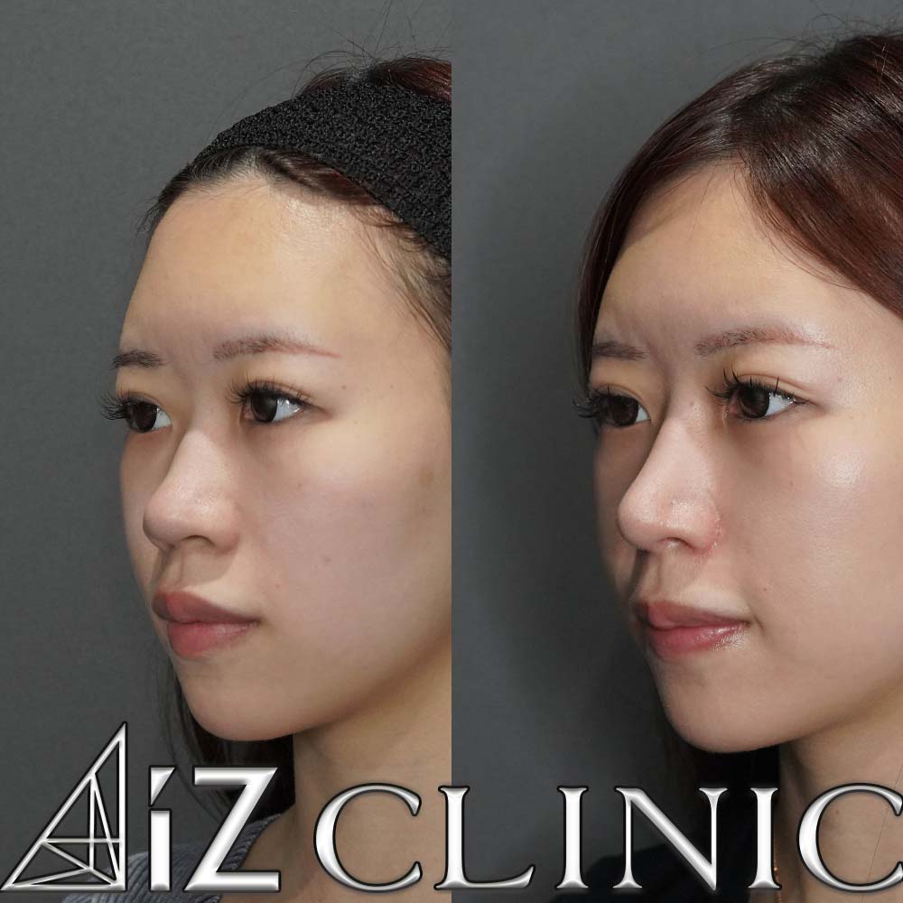 鼻中核延長、鼻尖形成ストラット法、小鼻縮小の一例