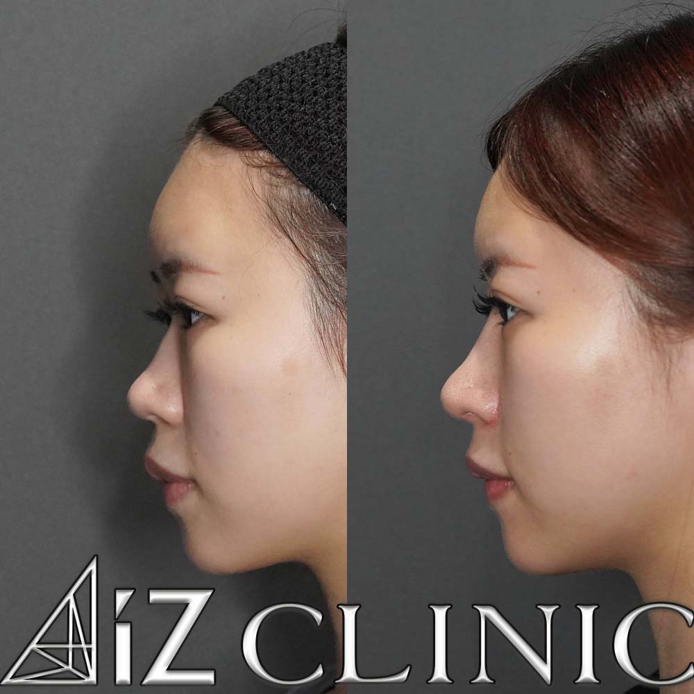 鼻中核延長、鼻尖形成ストラット法、小鼻縮小の一例