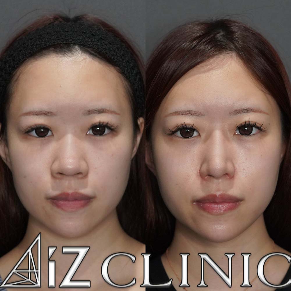 鼻中核延長、鼻尖形成ストラット法、小鼻縮小の一例