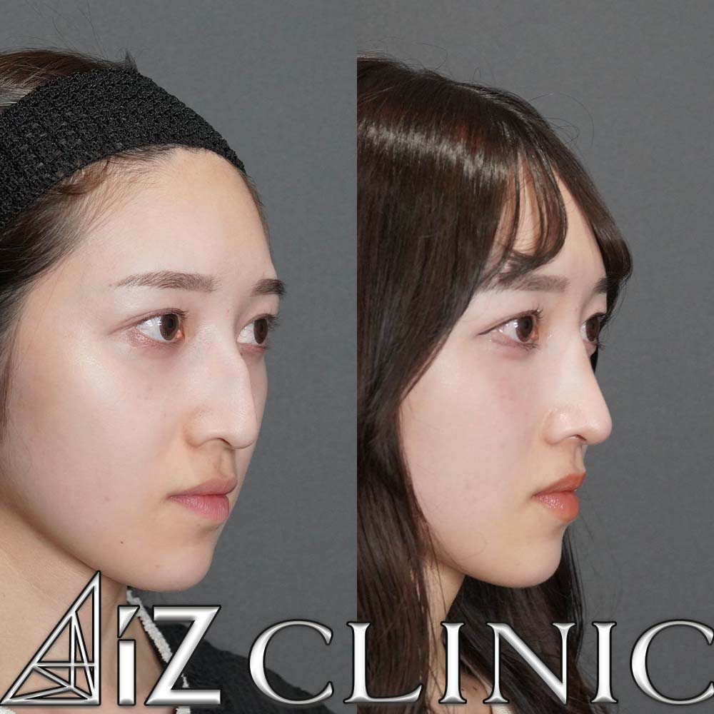 ハンプが強い場合の修正症例