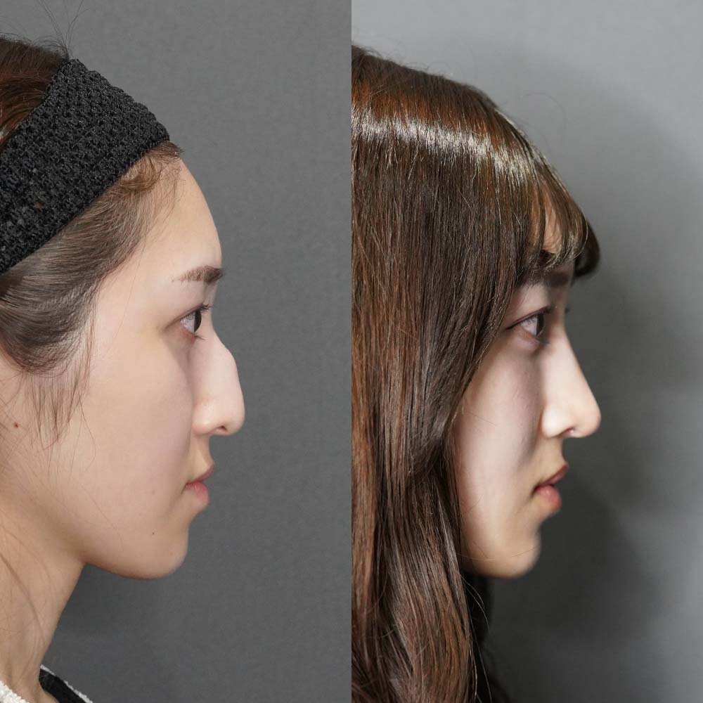 ハンプが強い場合の修正症例