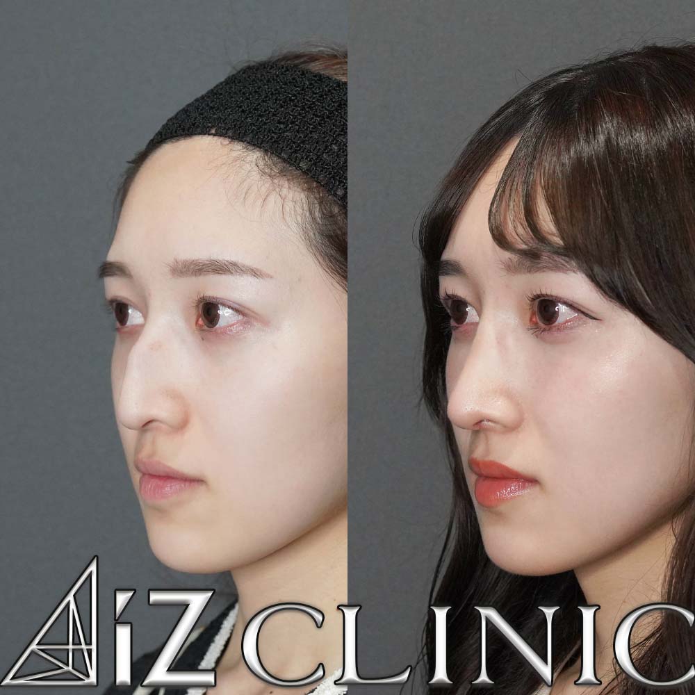 ハンプが強い場合の修正症例