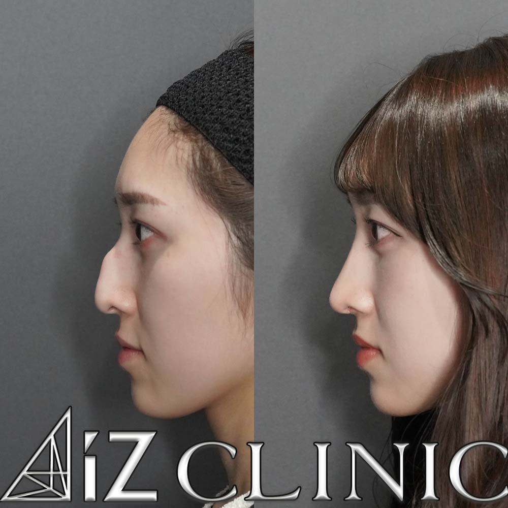 ハンプが強い場合の修正症例