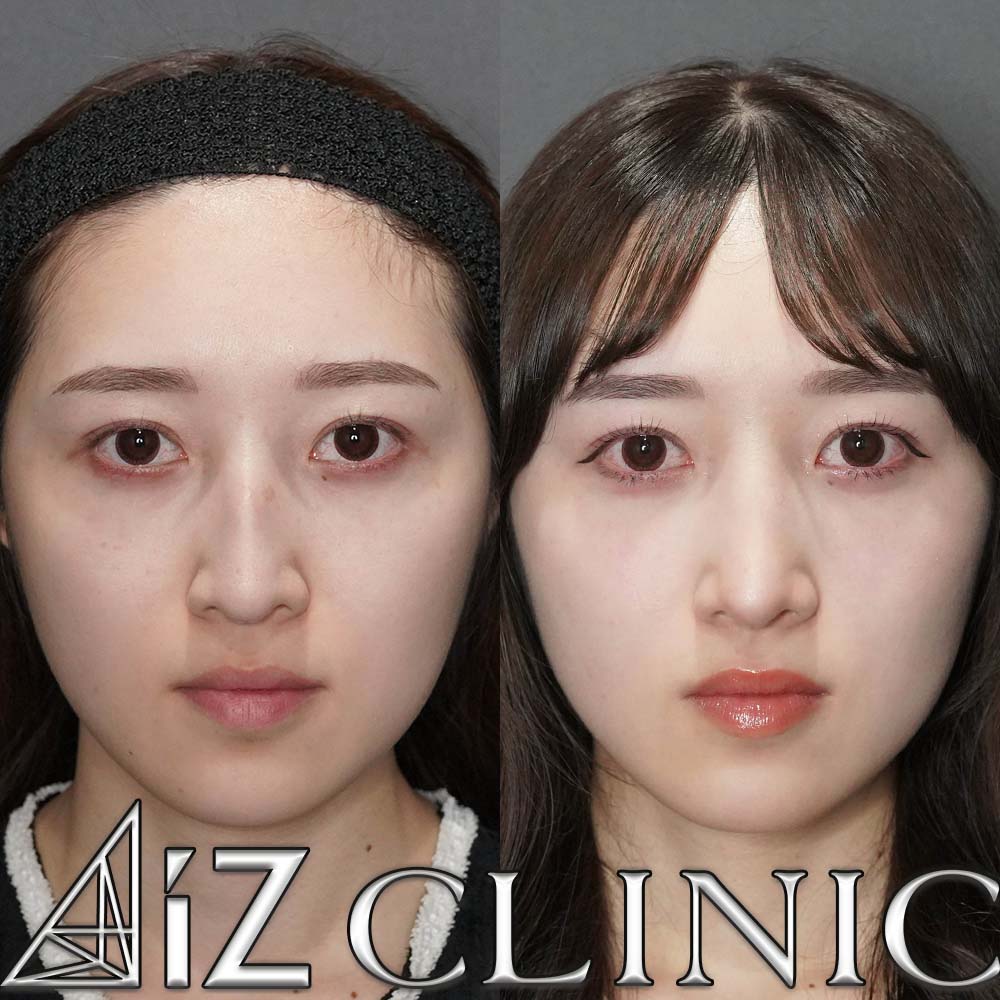 ハンプが強い場合の修正症例