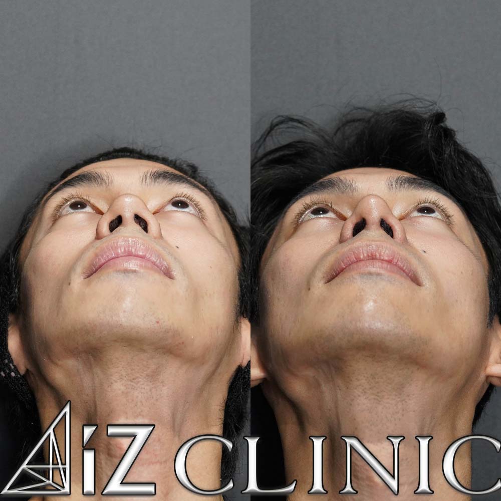 鼻尖形成ストラット法、軟骨移植、厚み縮小の術後1ヶ月