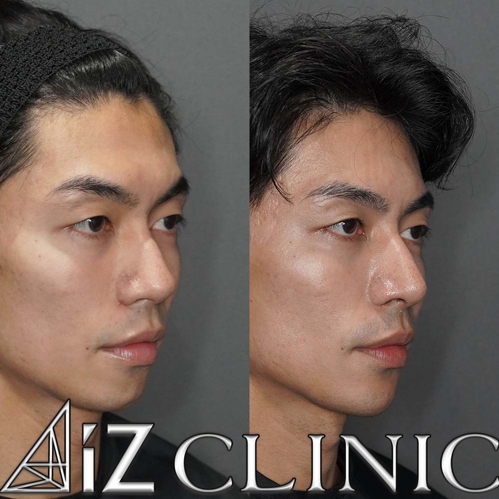 鼻尖形成ストラット法、軟骨移植、厚み縮小の術後1ヶ月