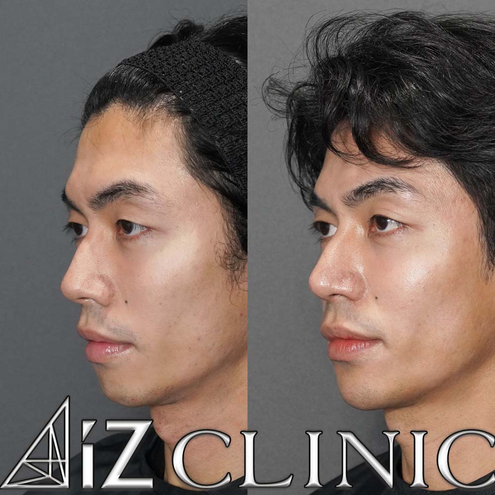 鼻尖形成ストラット法、軟骨移植、厚み縮小の術後1ヶ月