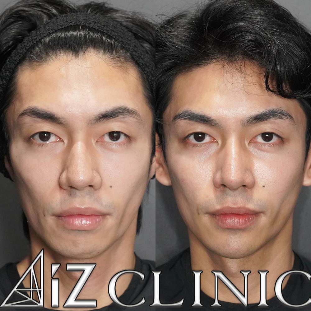 鼻尖形成ストラット法、軟骨移植、厚み縮小の術後1ヶ月