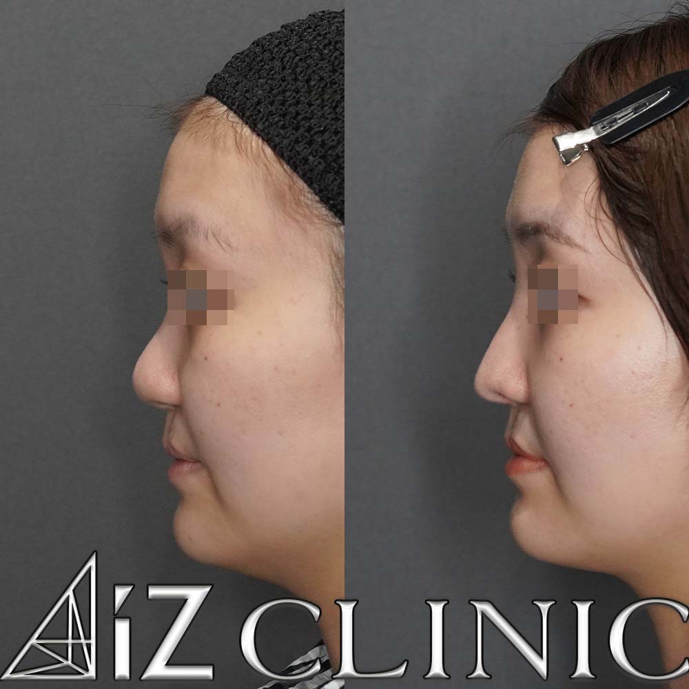 口唇口蓋裂の修正手術