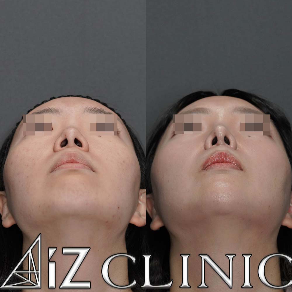 鼻フルで忘れ鼻を目指した一例