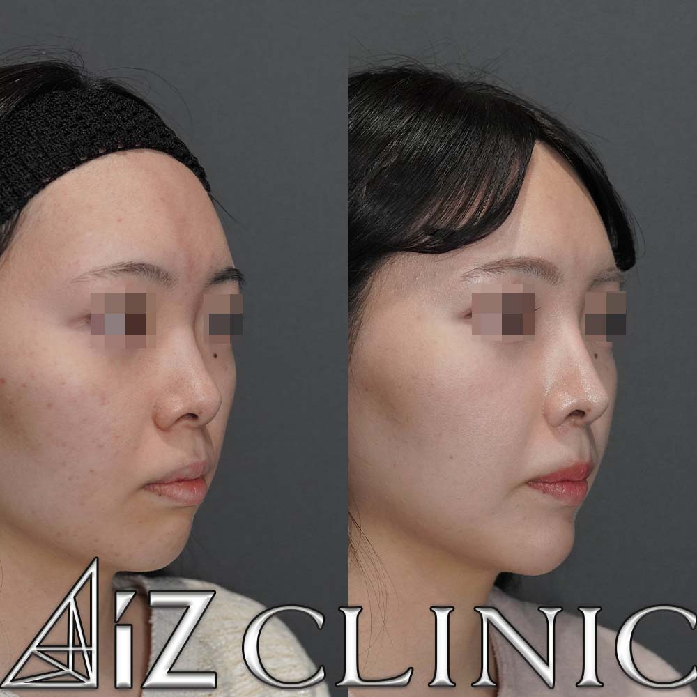 鼻フルで忘れ鼻を目指した一例