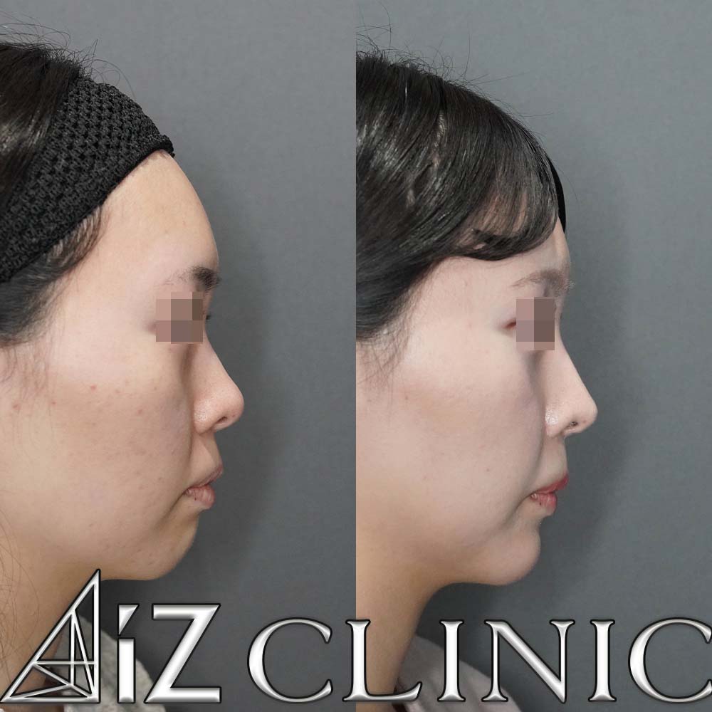 鼻フルで忘れ鼻を目指した一例