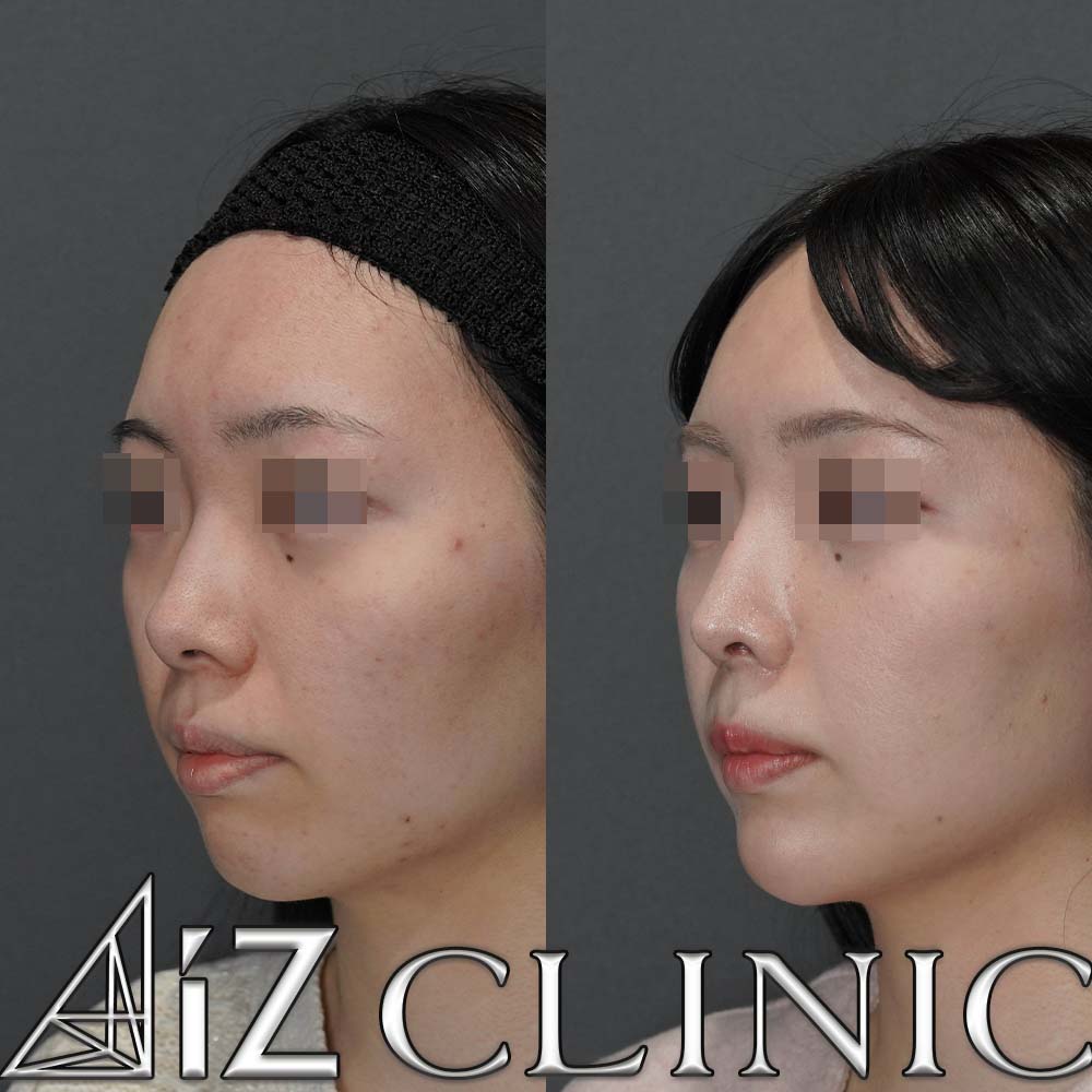 鼻フルで忘れ鼻を目指した一例