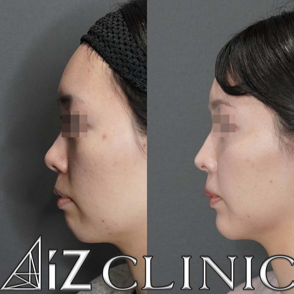 鼻フルで忘れ鼻を目指した一例