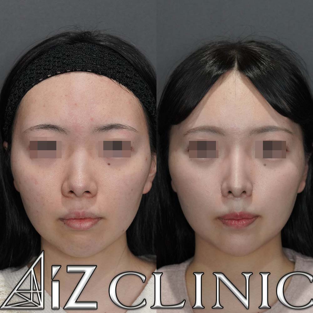 鼻フルで忘れ鼻を目指した一例