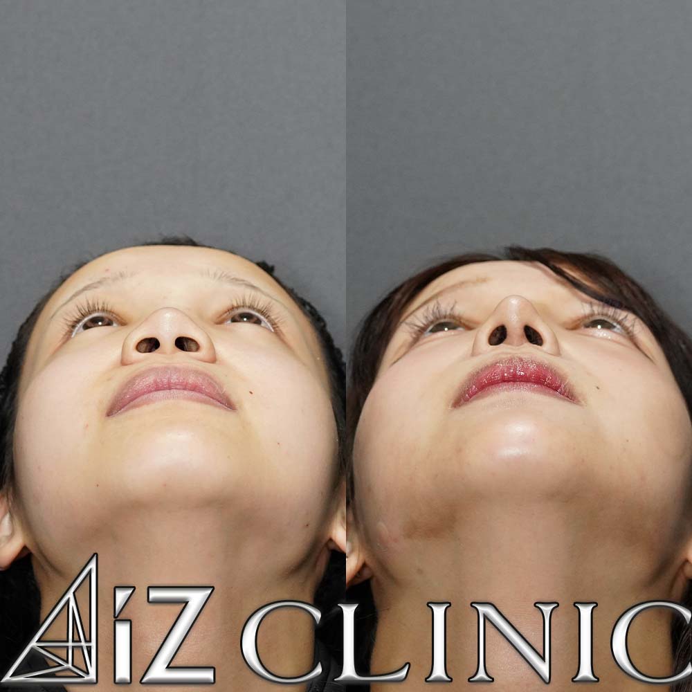 鼻の大きさを小さくして綺麗な忘鼻に