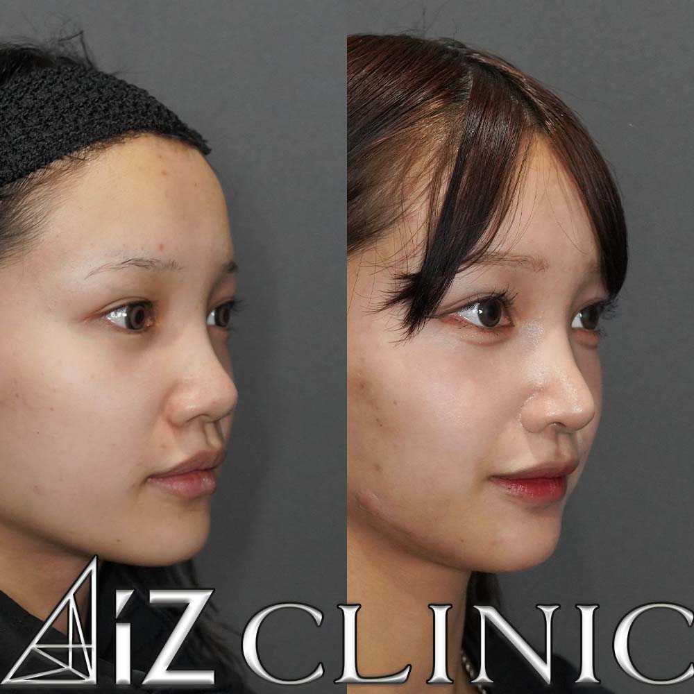 鼻の大きさを小さくして綺麗な忘鼻に