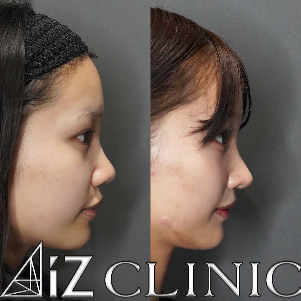 鼻の大きさを小さくして綺麗な忘鼻に