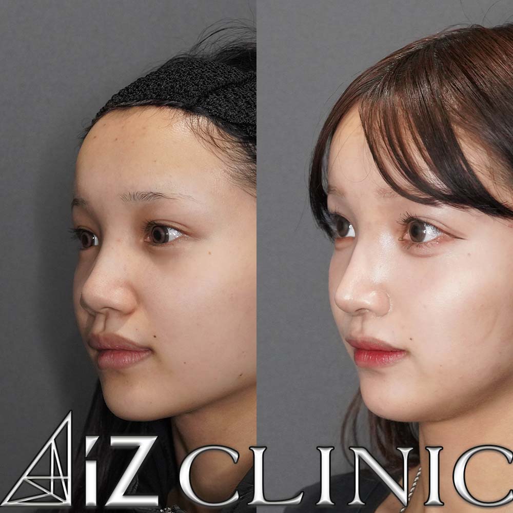 鼻の大きさを小さくして綺麗な忘鼻に