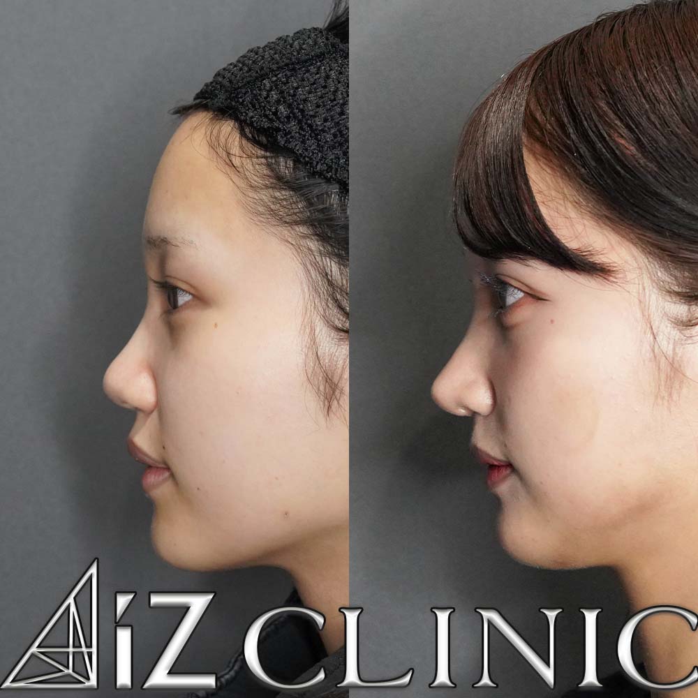 鼻の大きさを小さくして綺麗な忘鼻に