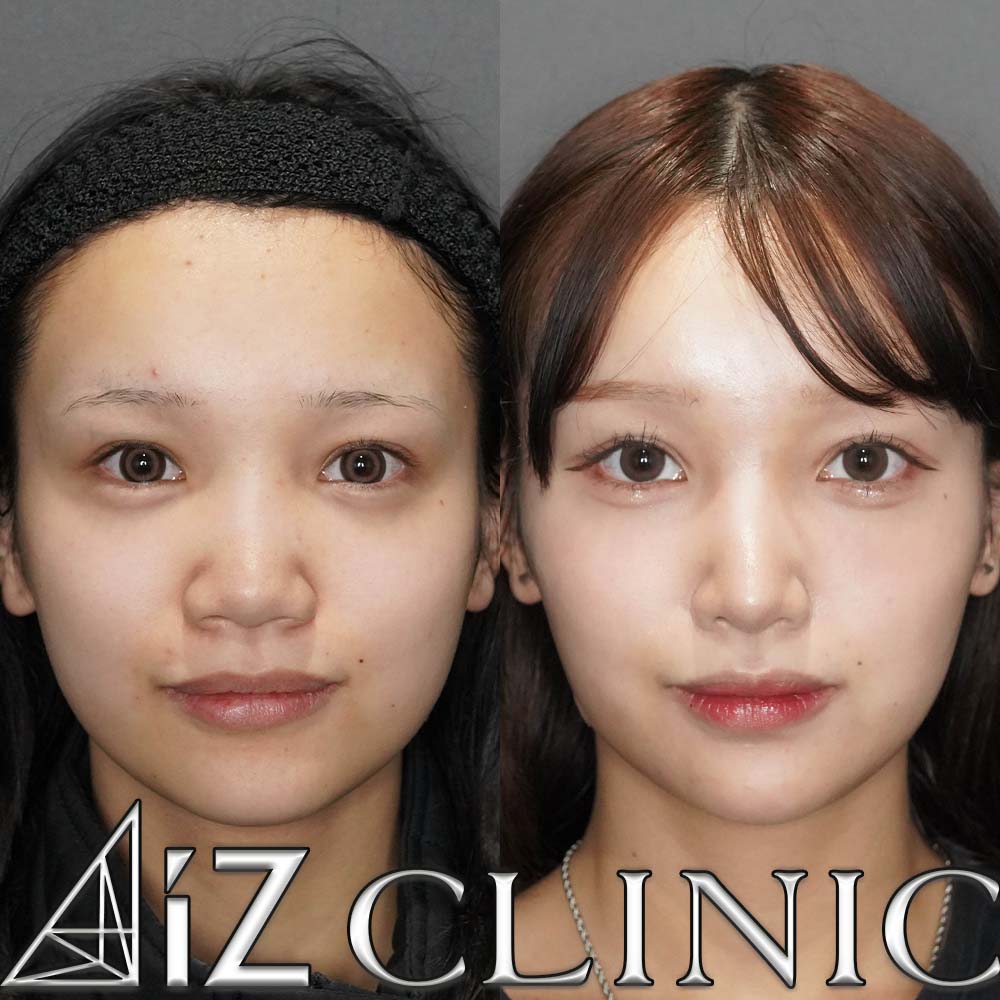 鼻の大きさを小さくして綺麗な忘鼻に