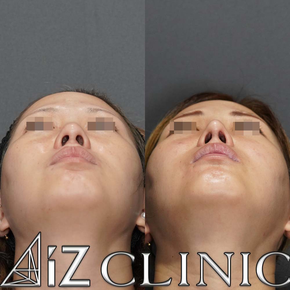 下からが大きく変わった一例