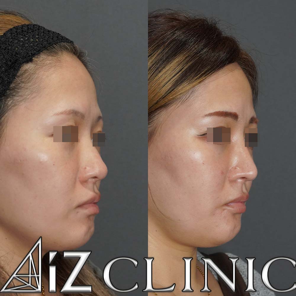 下からが大きく変わった一例