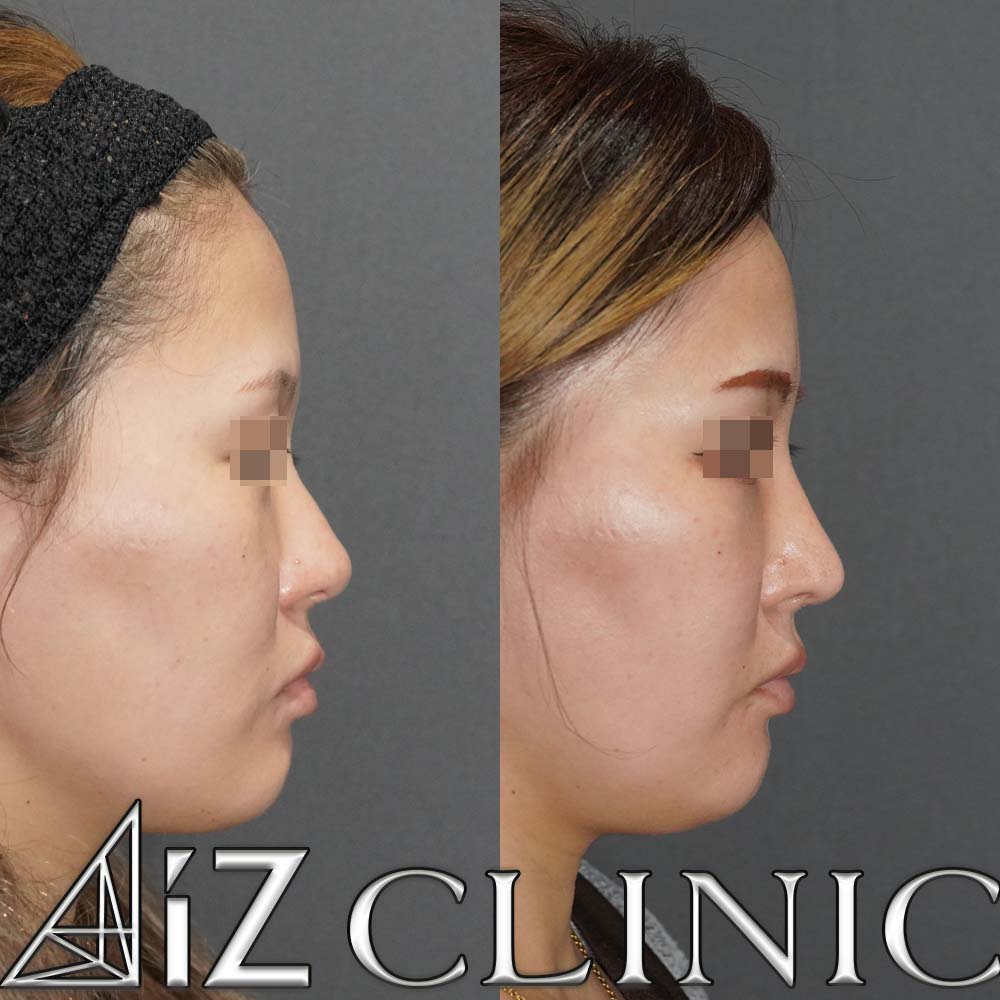 下からが大きく変わった一例