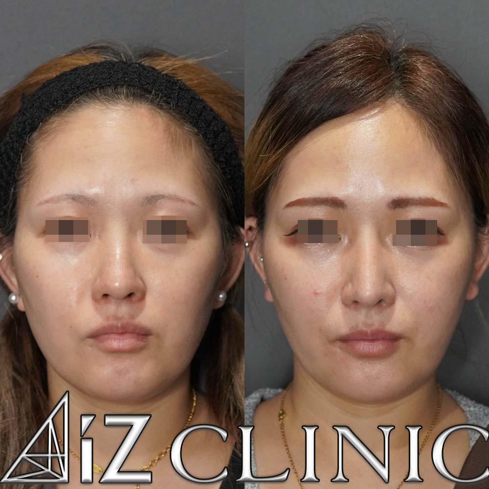 下からが大きく変わった一例