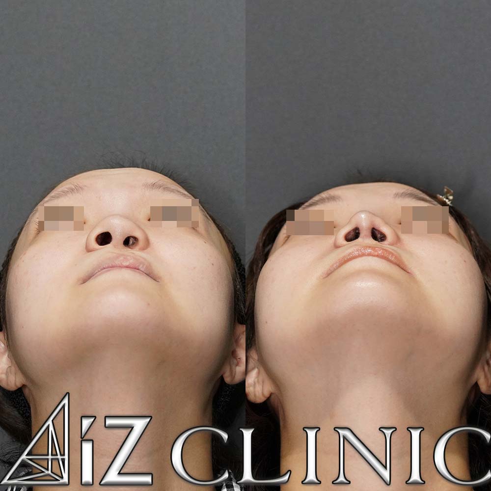 口唇口蓋裂の修正手術