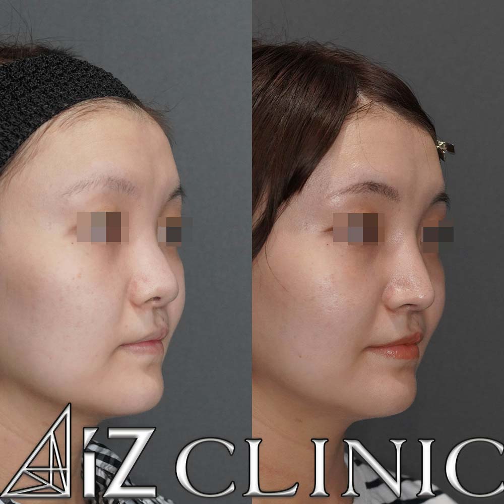 口唇口蓋裂の修正手術