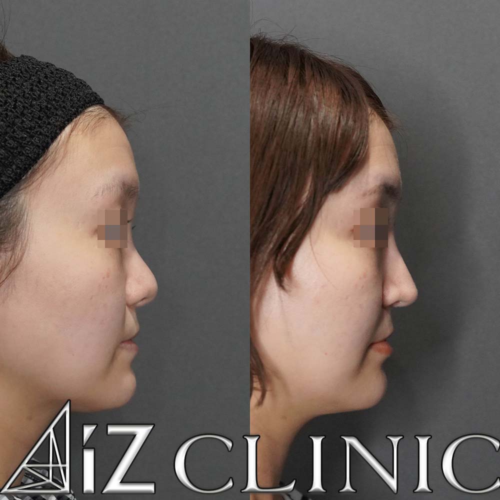 口唇口蓋裂の修正手術