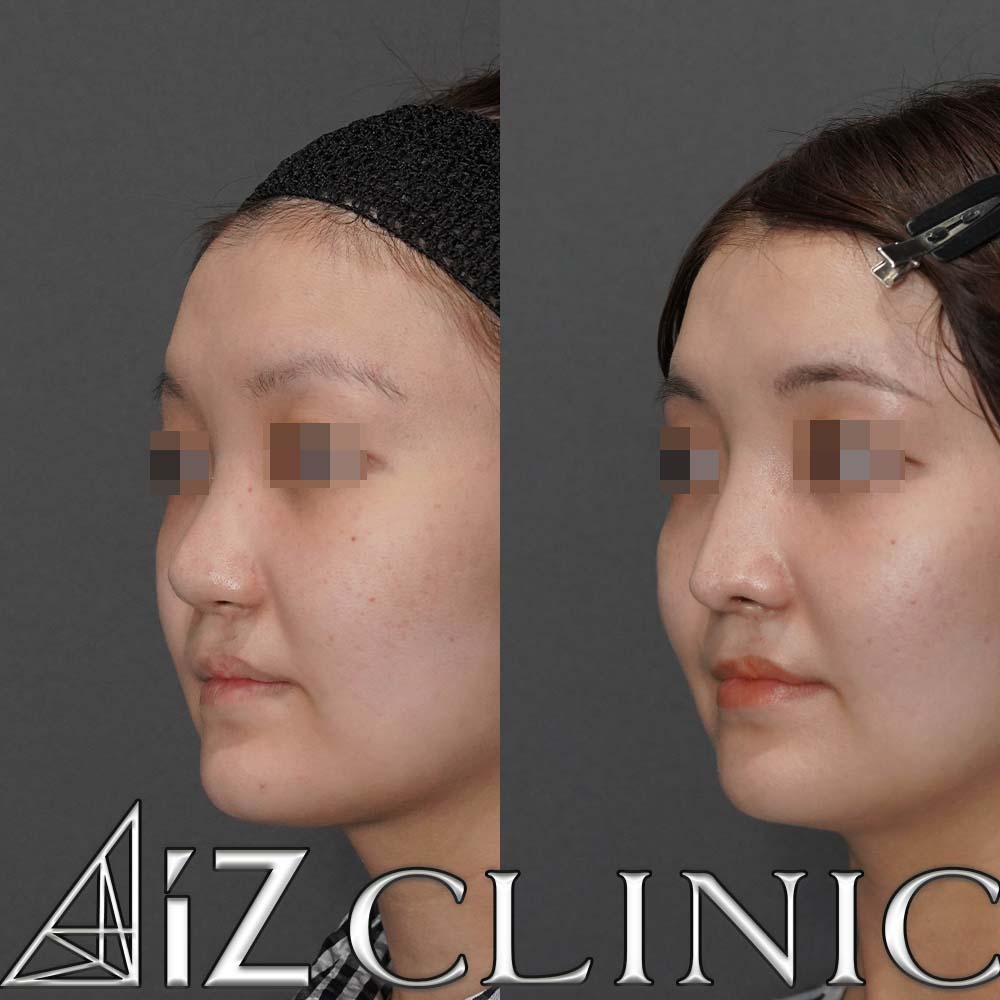 口唇口蓋裂の修正手術