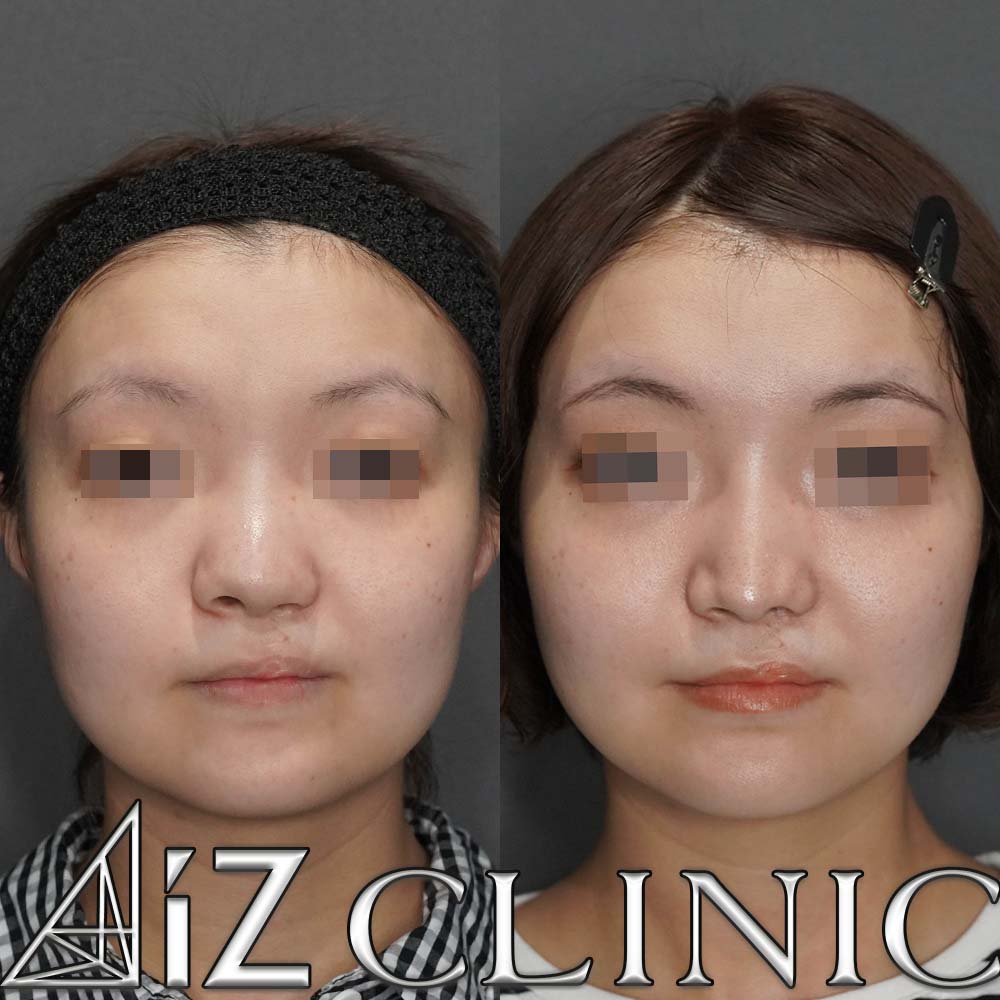 鼻尖形成ストラット法、軟骨移植、鼻中隔延長、b鼻孔縁挙上術、プロテーゼ入れ替えの術後３ヶ月