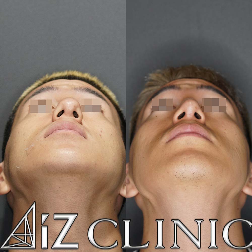 曲がった鼻の修正