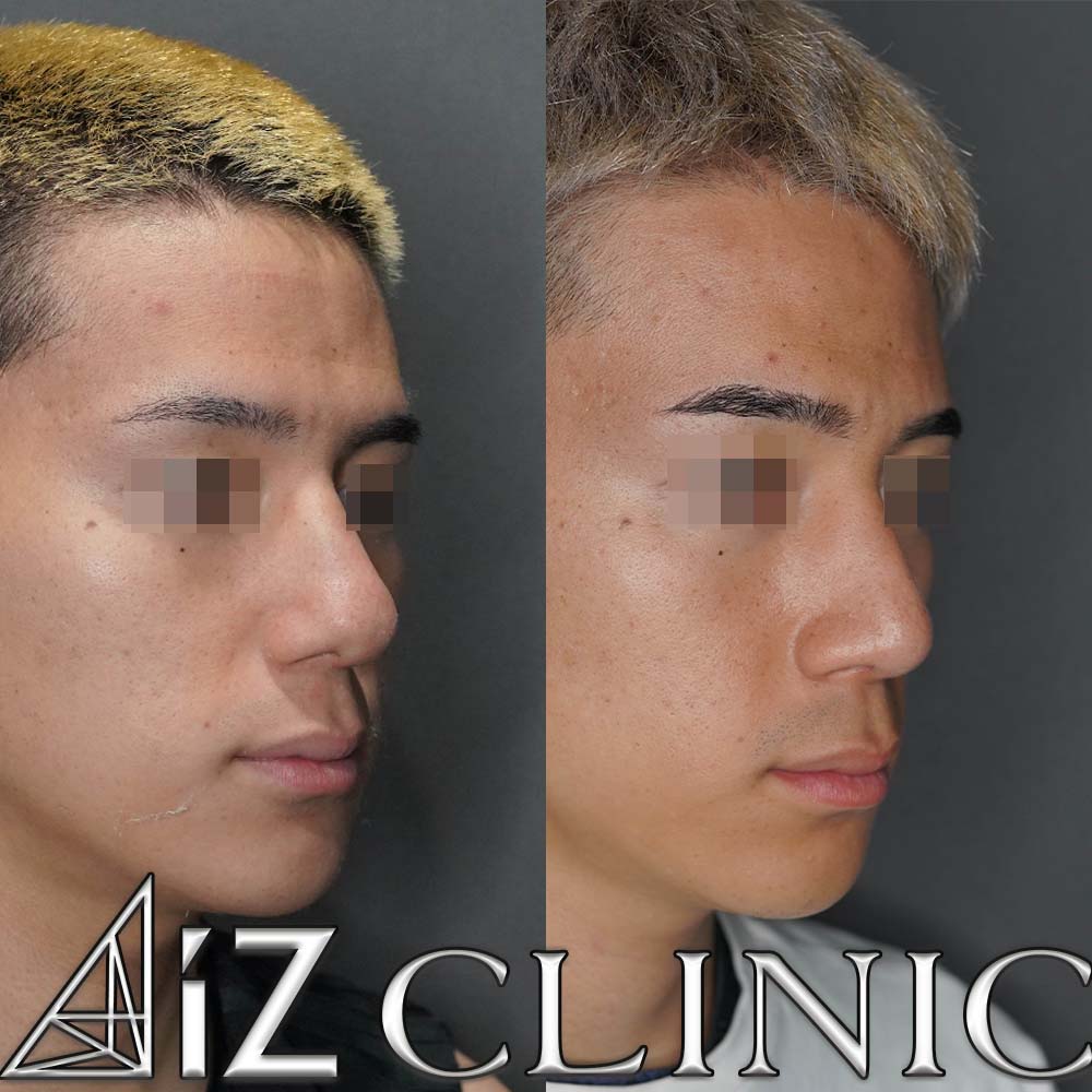 曲がった鼻の修正