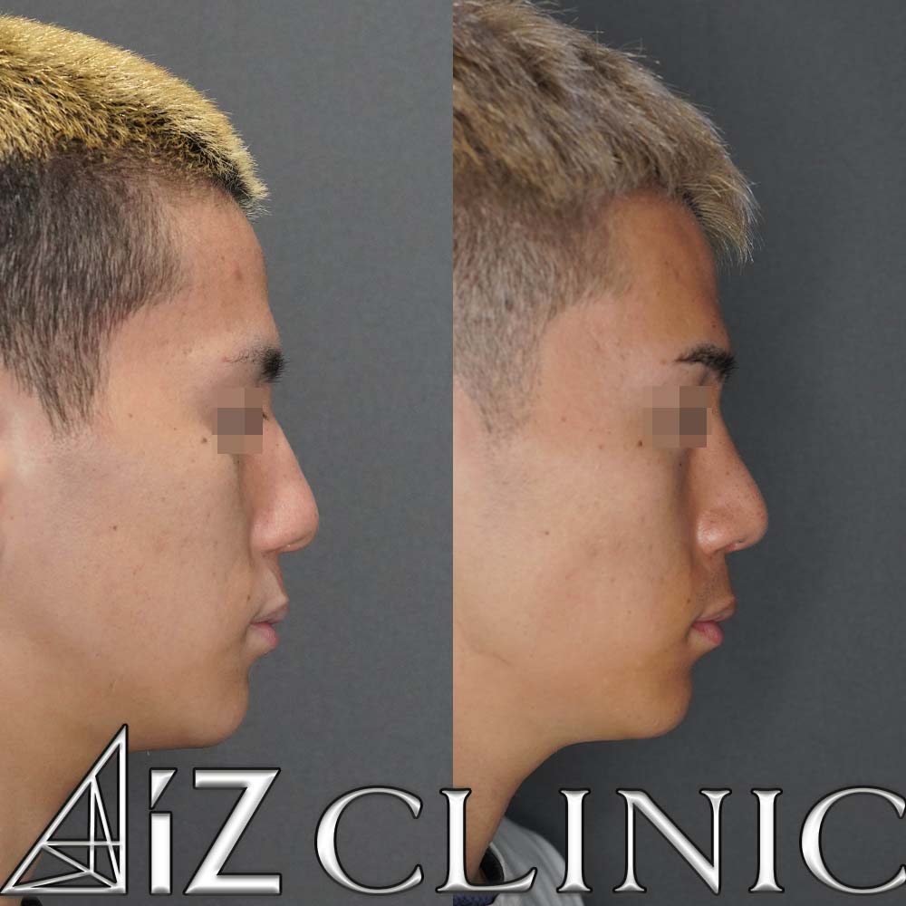 曲がった鼻の修正