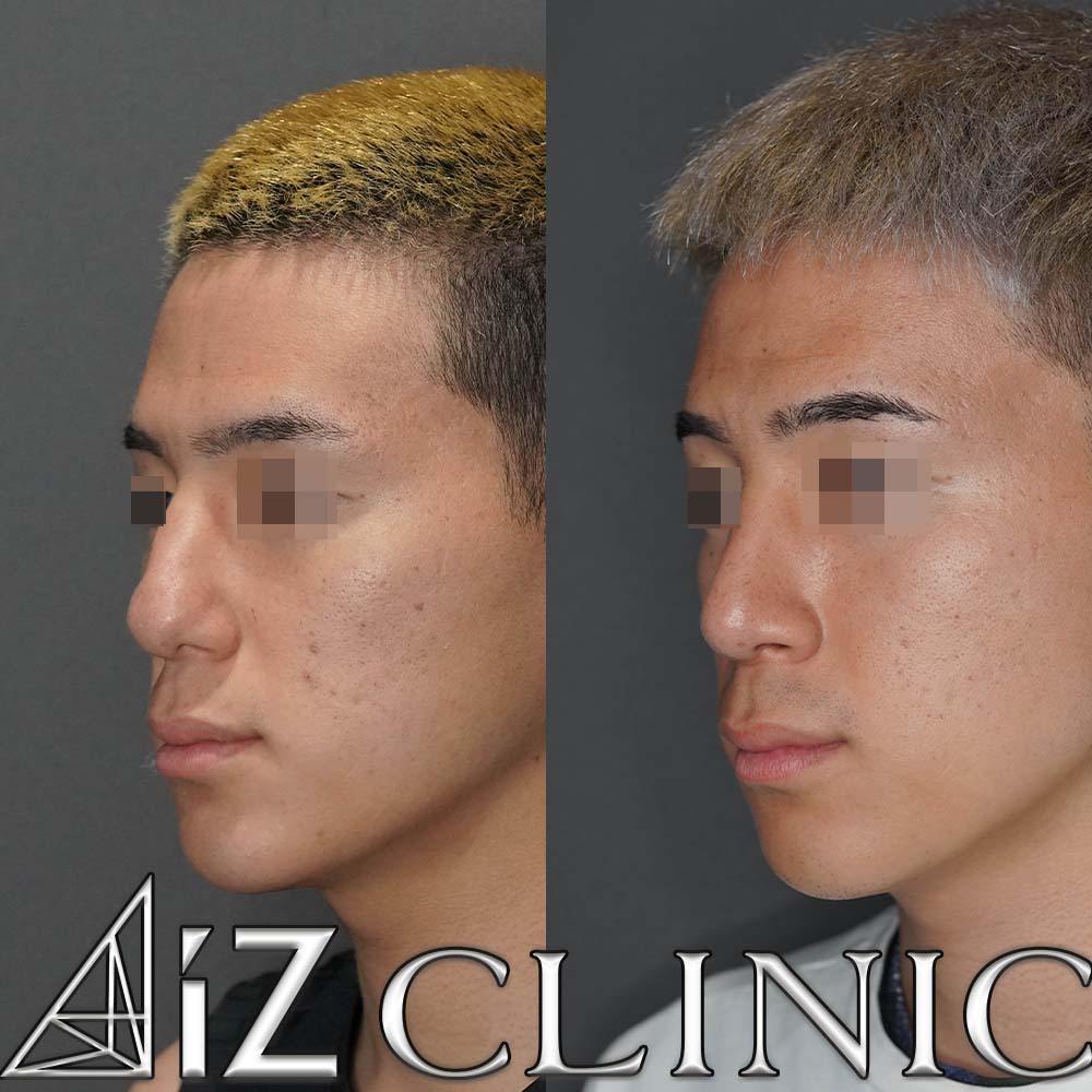 曲がった鼻の修正