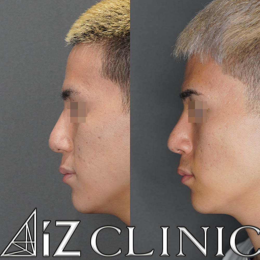 曲がった鼻の修正