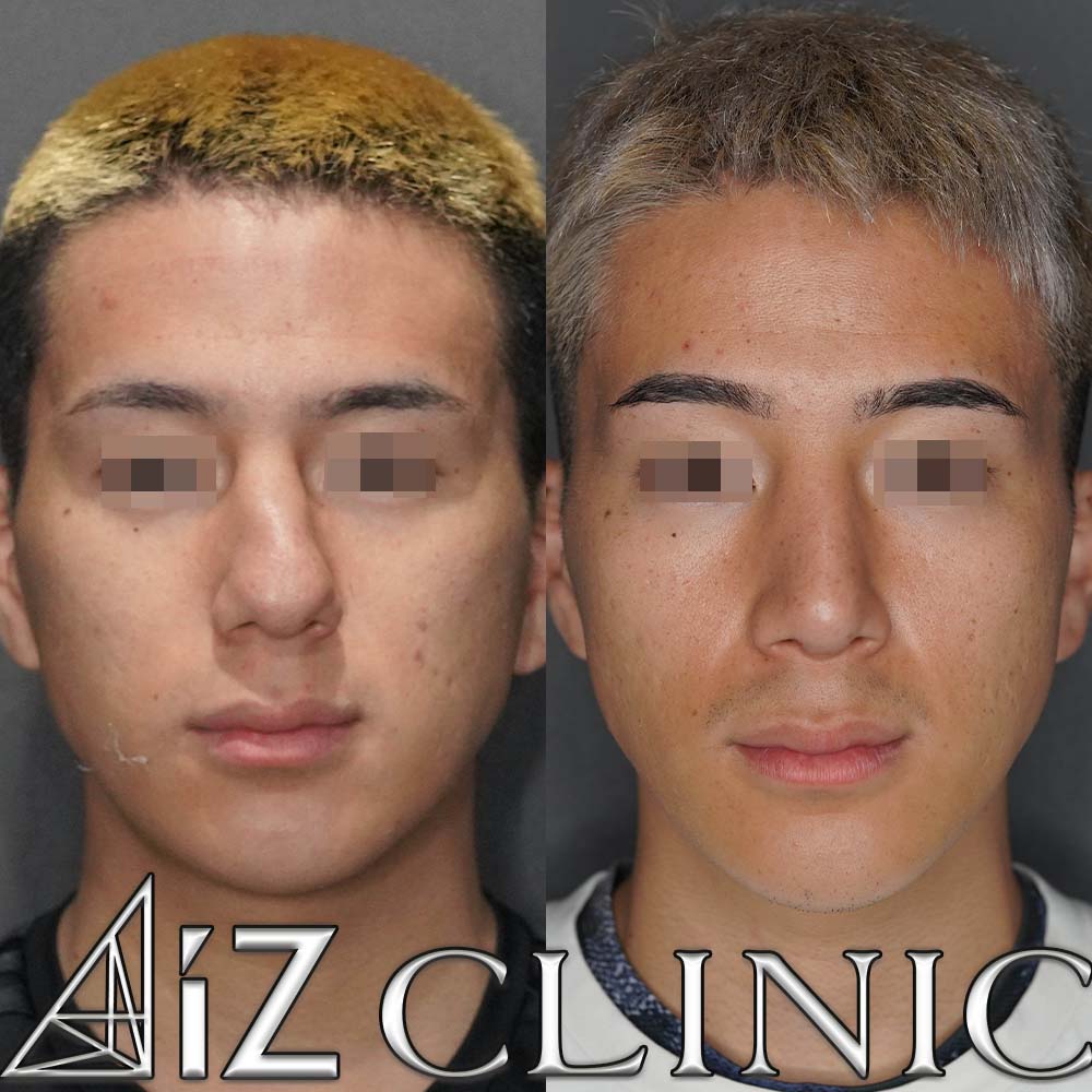 曲がった鼻の修正