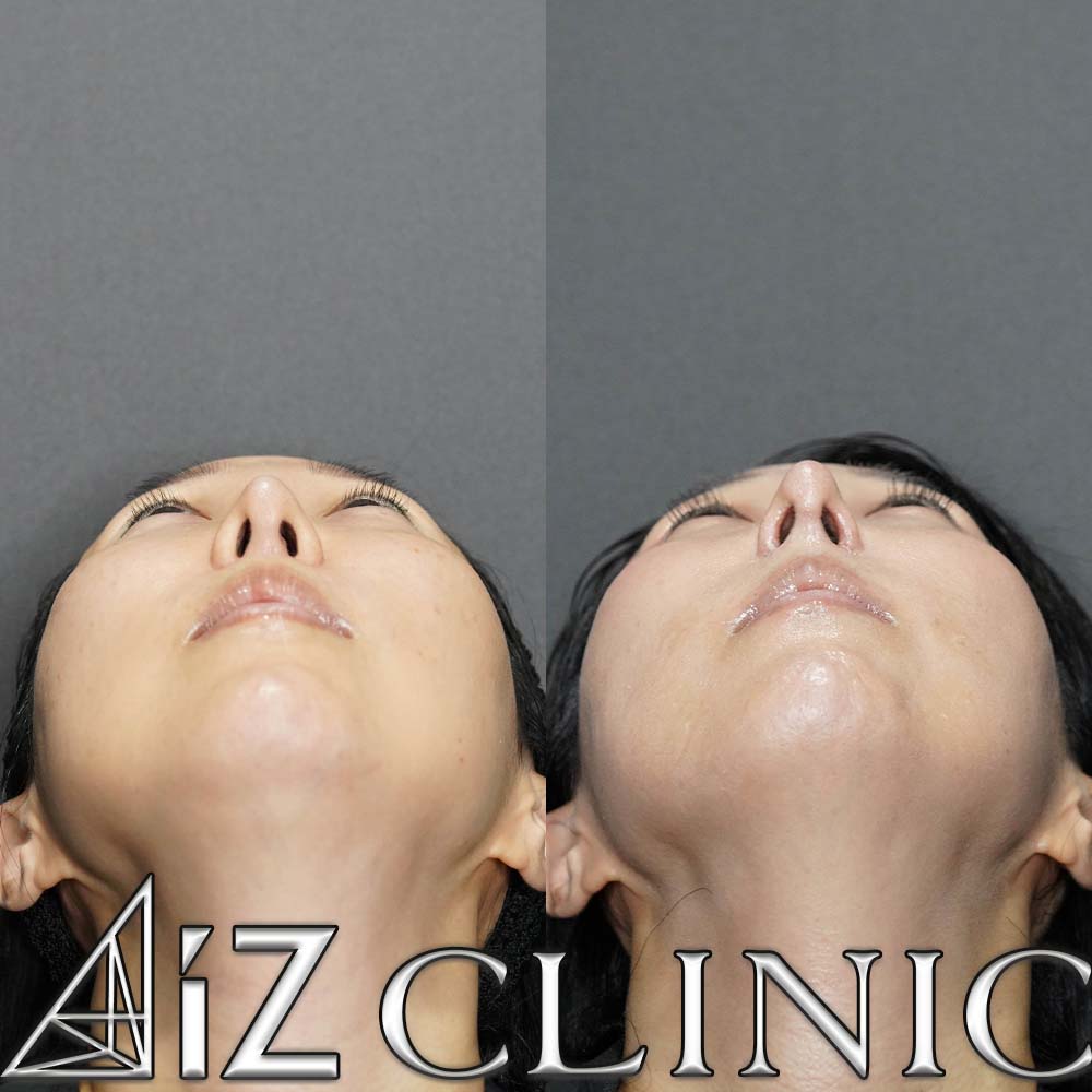 L型プロテーゼの入れ替え修正