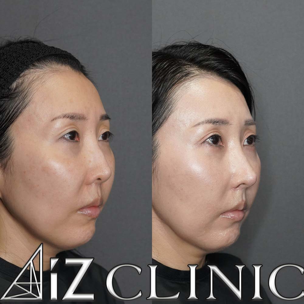 L型プロテーゼの入れ替え修正