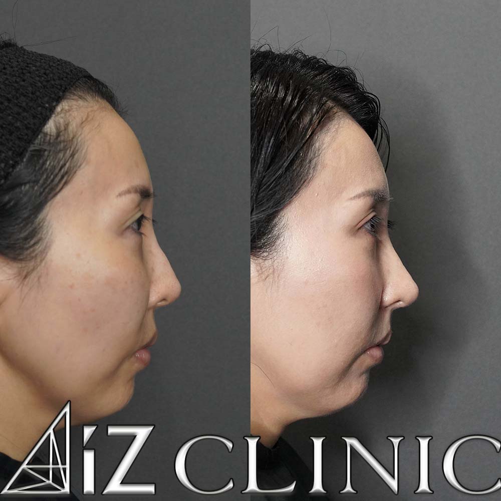 L型プロテーゼの入れ替え修正