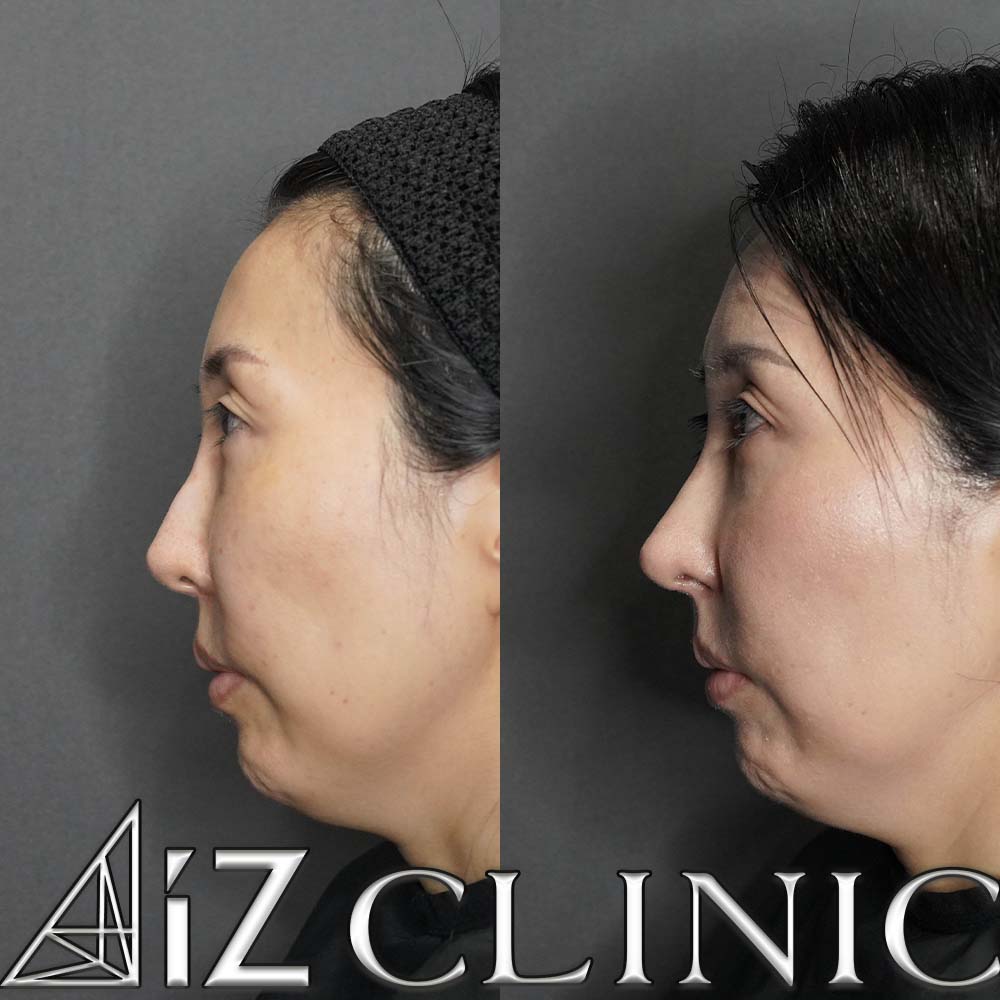 L型プロテーゼの入れ替え修正