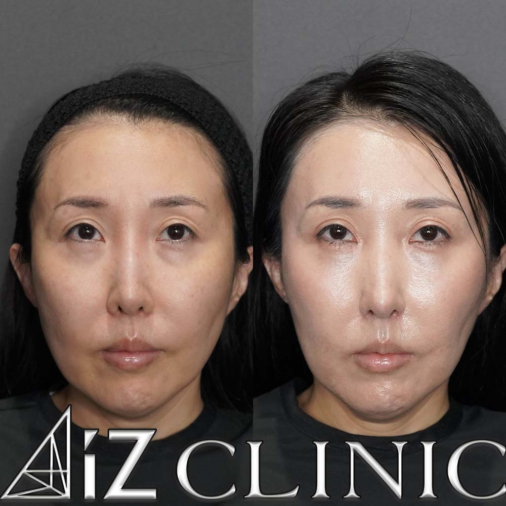 鼻尖形成ストラット法、軟骨移植、鼻中隔延長、小鼻の厚み縮小、プロテーゼ入れ替えの術後１ヶ月